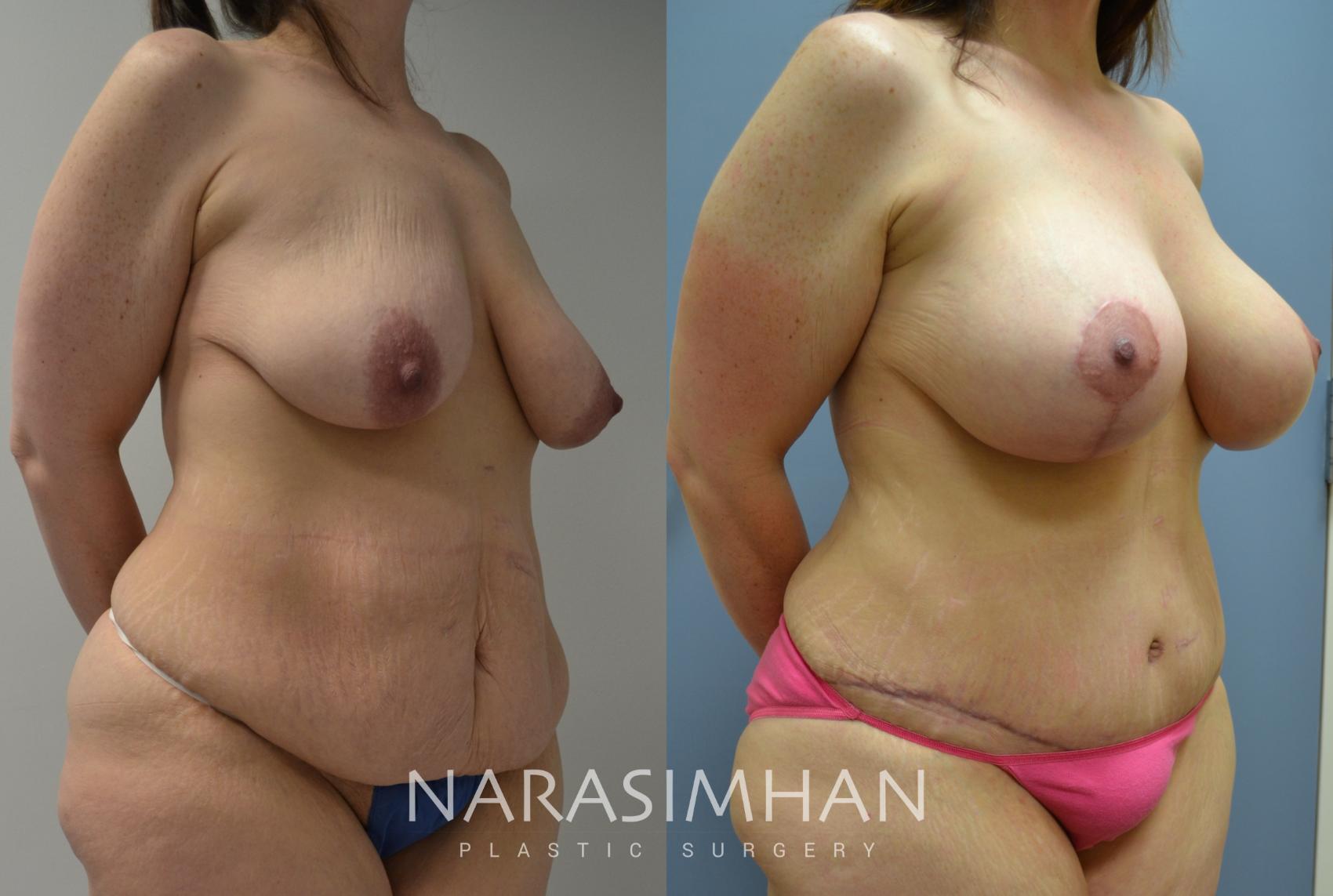 Before & After Tummy Tuck (Abdominoplasty) Case 19 View #1 View in St Petersburg, Florida