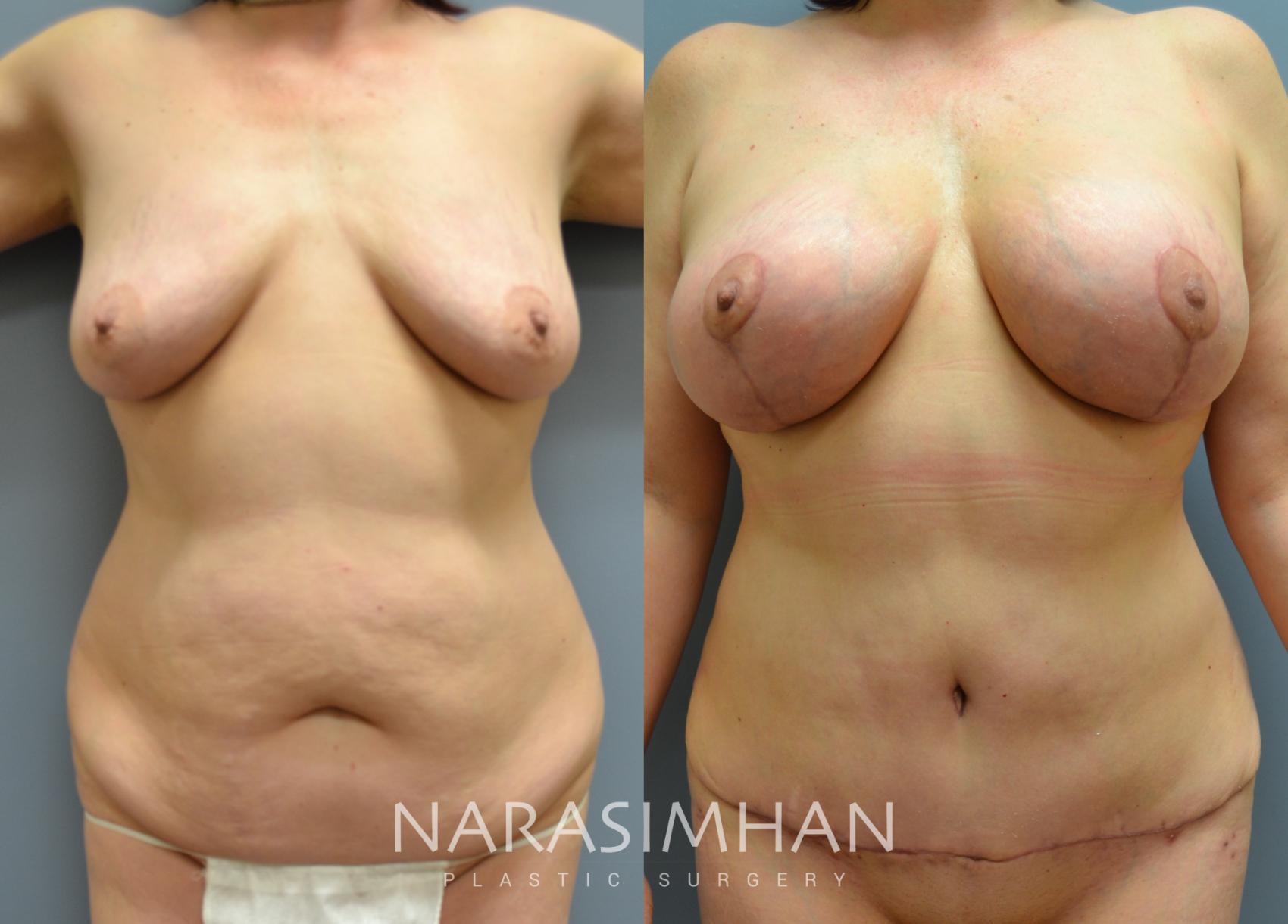 Before & After Tummy Tuck (Abdominoplasty) Case 34 View #1 View in St Petersburg, Florida