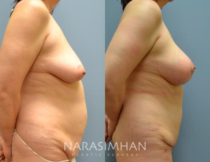 Before & After Mastopexy Case 34 View #2 View in Tampa, Florida