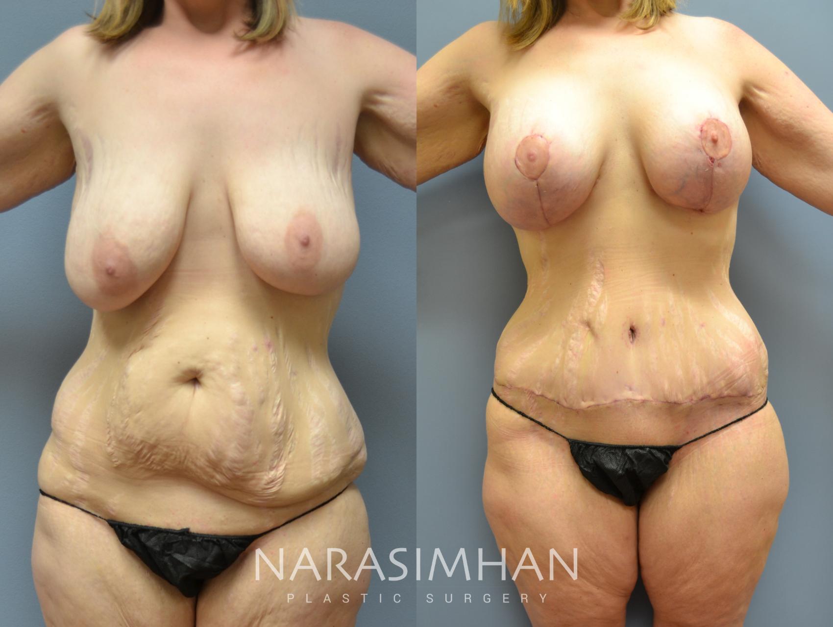 Before & After Post-Weight Loss / Post-Bariatric Skin Tightening Case 35 View #1 View in Tampa, Florida