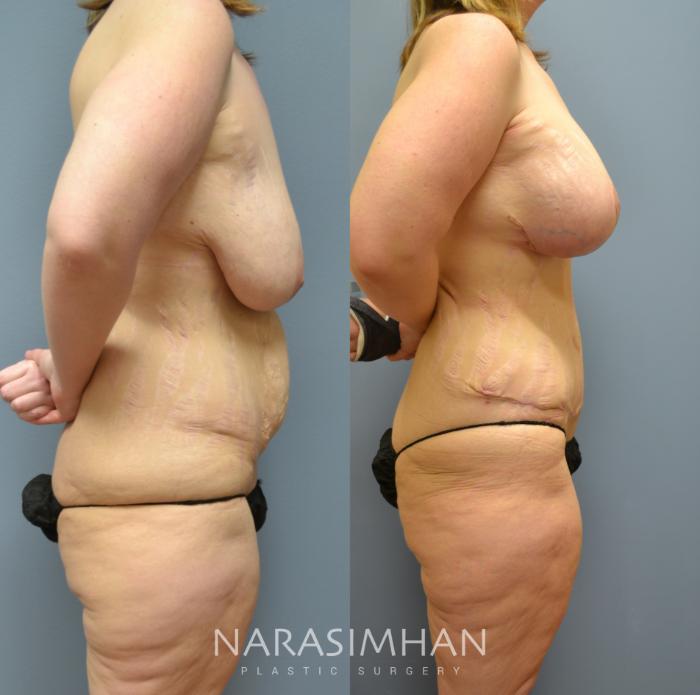 Before & After Post-Weight Loss / Post-Bariatric Skin Tightening Case 35 View #2 View in St Petersburg, Florida
