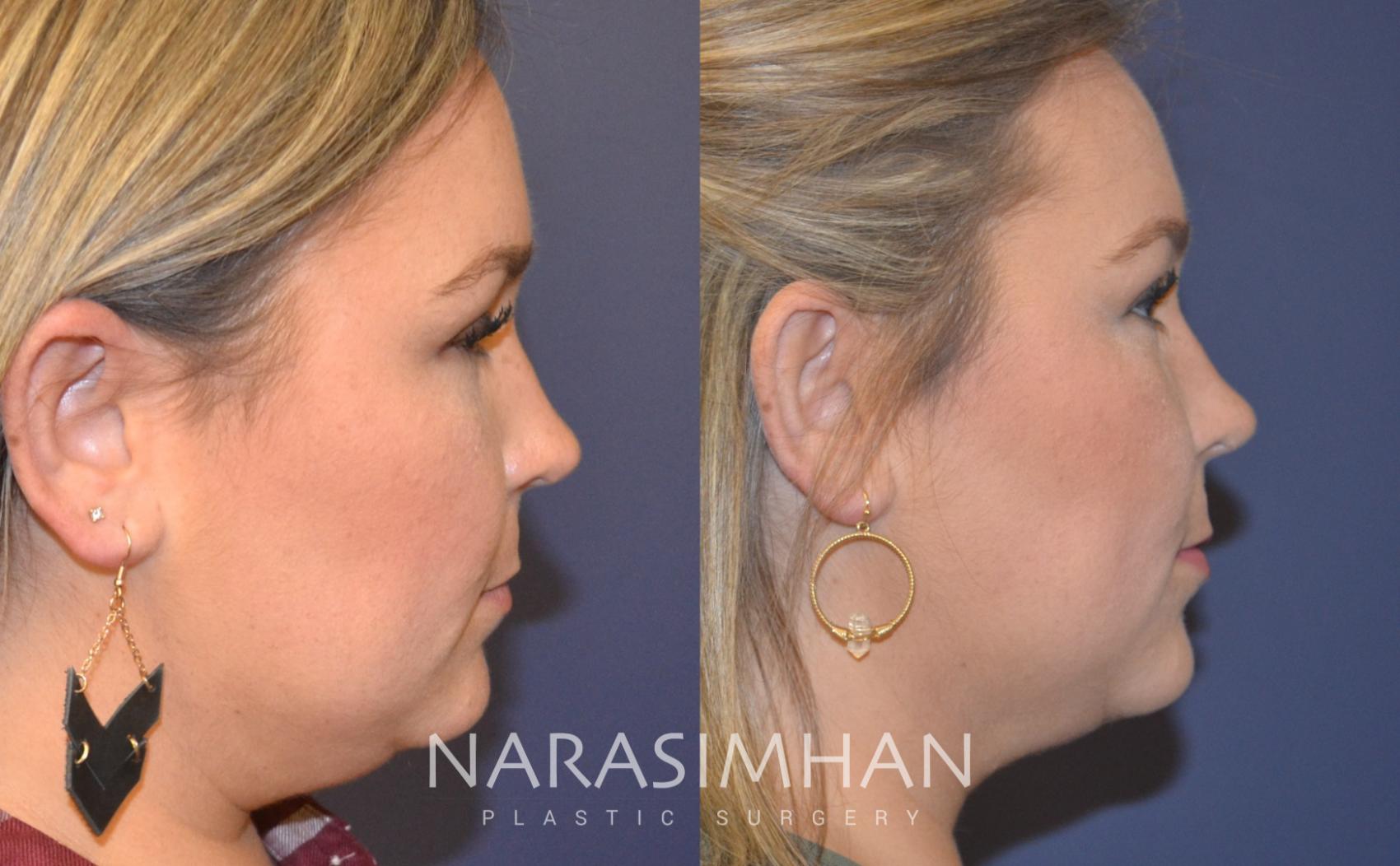 Before & After Necklift Case 107 View #1 View in St Petersburg, Florida