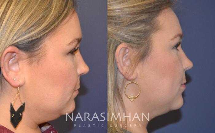 Before & After Liposuction Case 107 View #1 View in Tampa, Florida