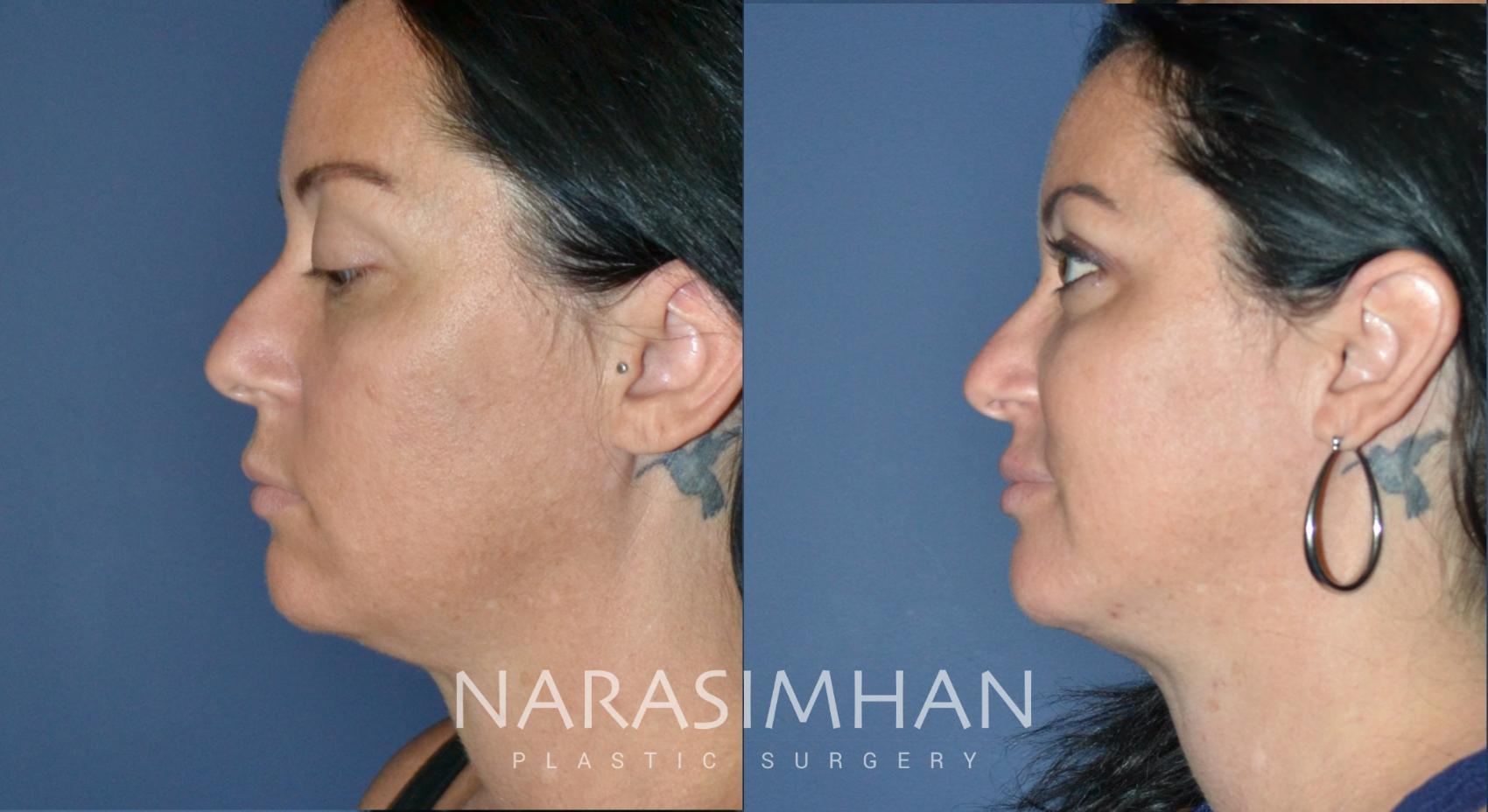 Before & After Necklift Case 184 View #1 View in St Petersburg, Florida