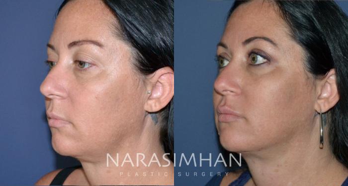 Before & After Necklift Case 184 View #2 View in Tampa, Florida