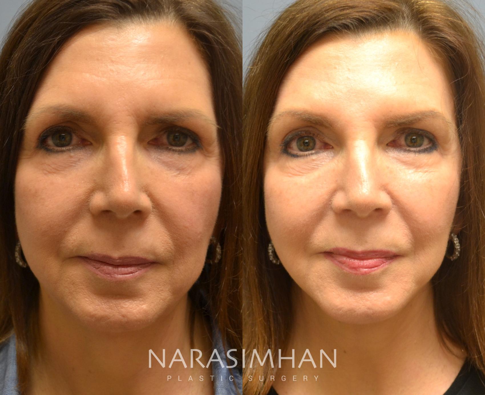 Skin Tightening  South Florida Facial Plastic Surgery