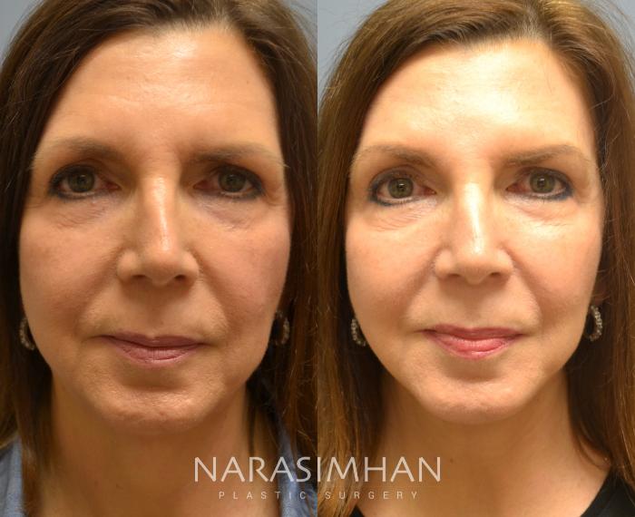 Before & After Necklift Case 67 View #1 View in Tampa, Florida