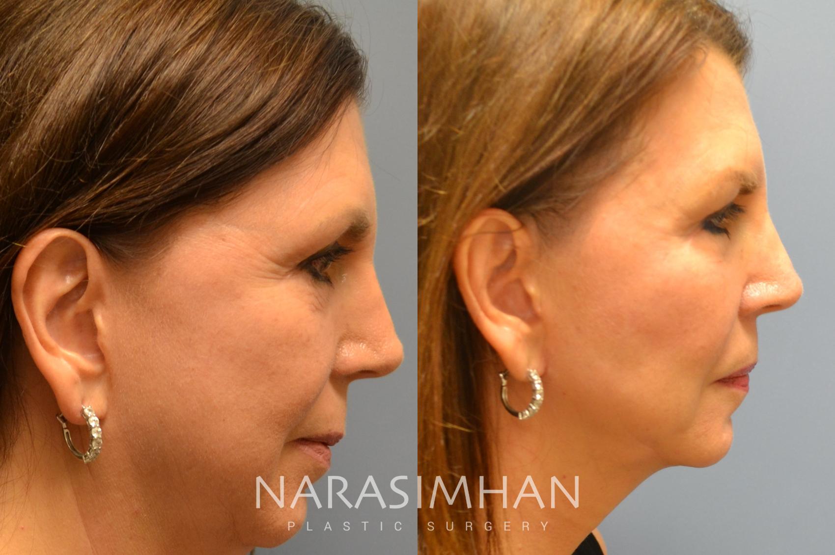 Before & After Necklift Case 67 View #2 View in St. Petersburg, Florida