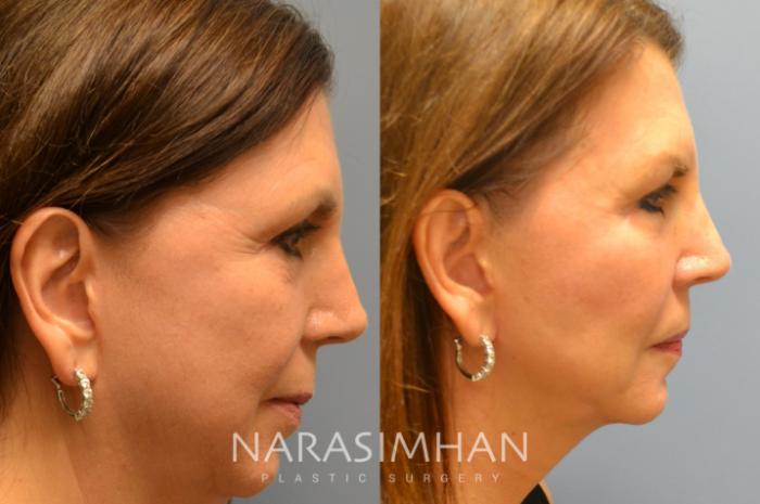 Before & After Necklift Case 67 View #2 View in Tampa, Florida