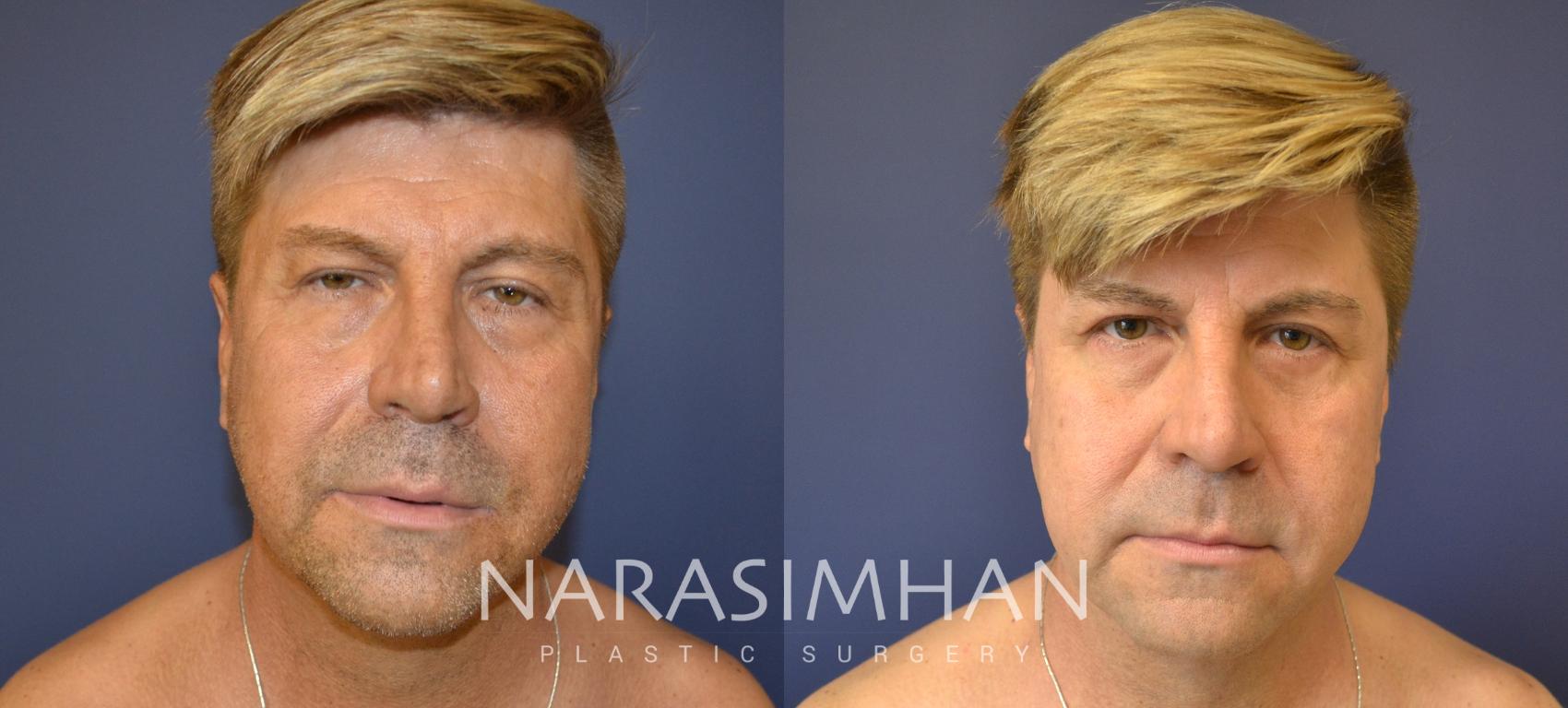 Before & After Necklift Case 87 View #1 View in St Petersburg, Florida