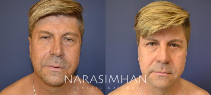 Before & After Liposuction Case 87 View #1 View in Tampa, Florida