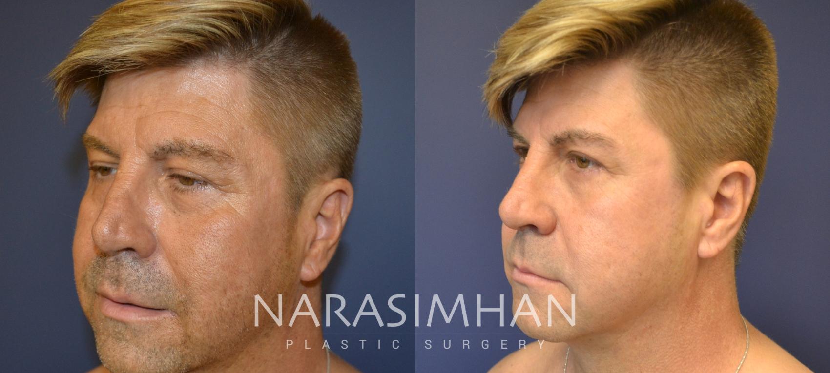 Before & After Necklift Case 87 View #2 View in St Petersburg, Florida
