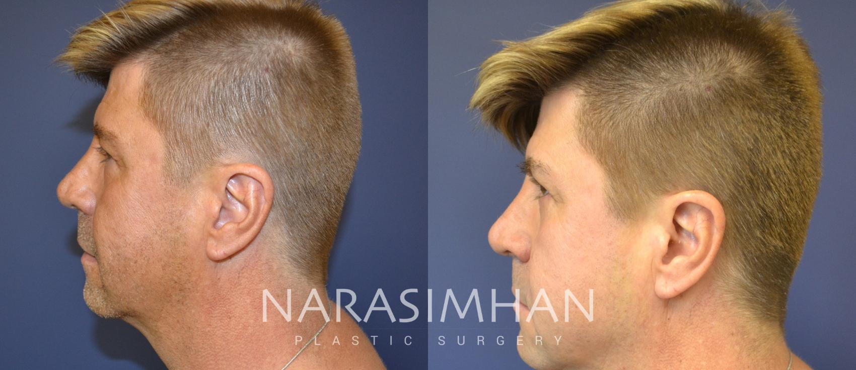 Before & After Necklift Case 87 View #3 View in St Petersburg, Florida
