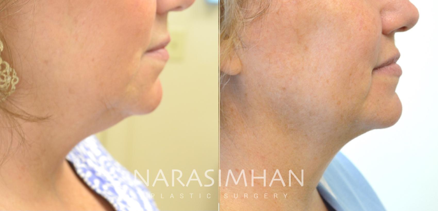Before & After Kybella Case 95 View #1 View in St Petersburg, Florida