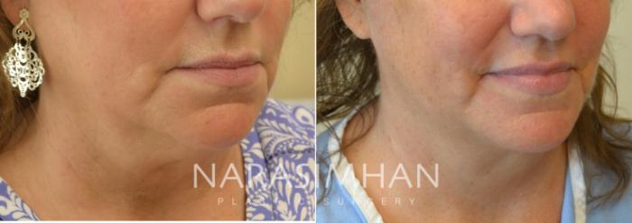 Before & After Necklift Case 95 View #2 View in Tampa, Florida