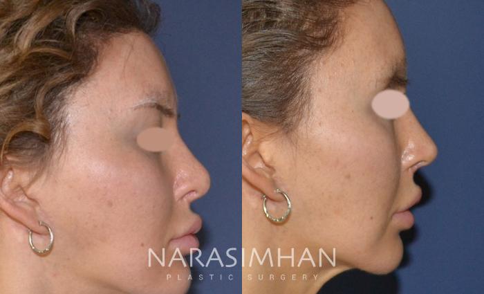 Before & After Revision Rhinoplasty Case 127 View #1 View in Tampa, Florida