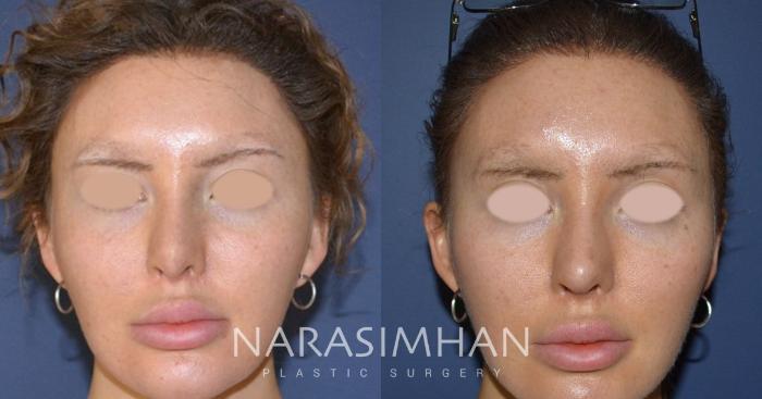 Before & After Revision Rhinoplasty Case 127 View #3 View in Tampa, Florida