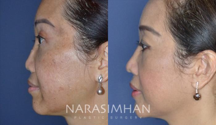 Before & After Revision Rhinoplasty Case 180 View #1 View in Tampa, Florida