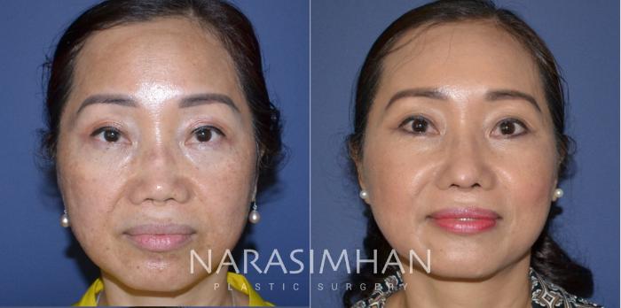 Before & After Revision Rhinoplasty Case 180 View #2 View in Tampa, Florida