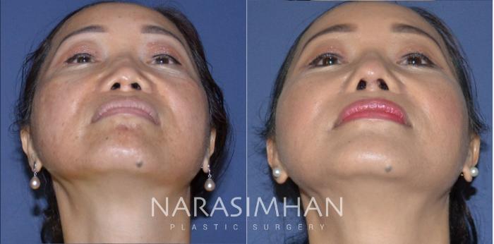 Before & After Revision Rhinoplasty Case 180 View #3 View in Tampa, Florida