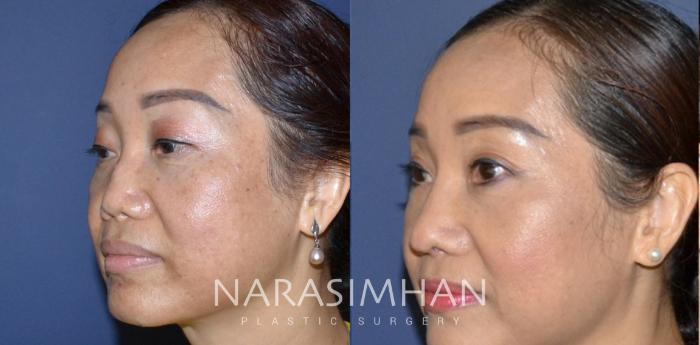 Before & After Revision Rhinoplasty Case 180 View #4 View in Tampa, Florida