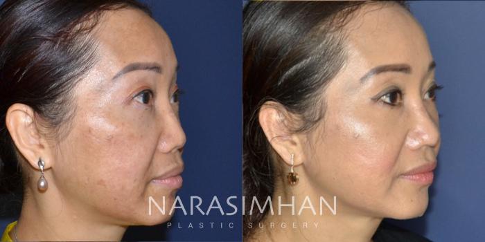 Before & After Revision Rhinoplasty Case 180 View #5 View in Tampa, Florida