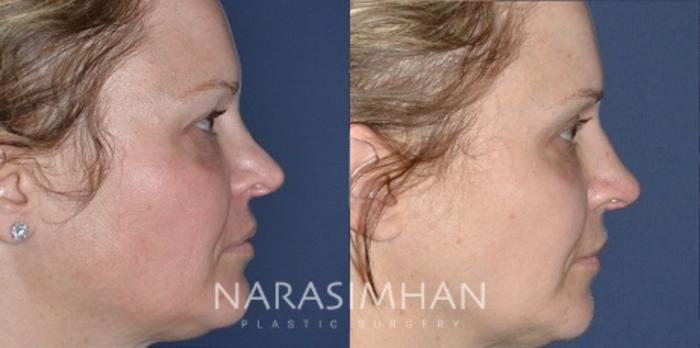 Before & After Revision Rhinoplasty Case 192 View #1 View in Tampa, Florida