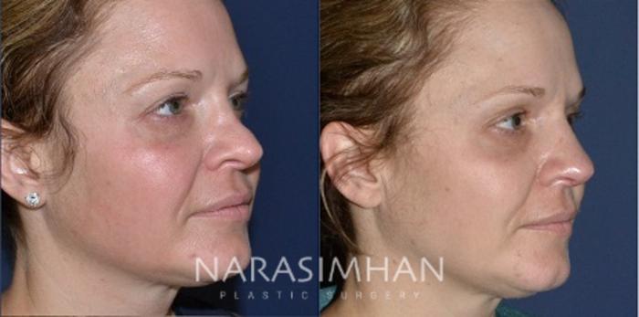 Before & After Revision Rhinoplasty Case 192 View #2 View in Tampa, Florida