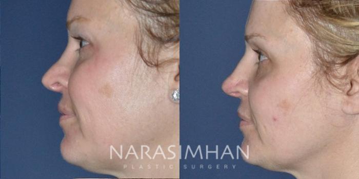 Before & After Revision Rhinoplasty Case 192 View #3 View in Tampa, Florida