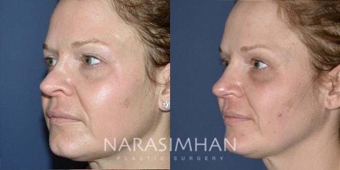 Before & After Revision Rhinoplasty Case 192 View #4 View in Tampa, Florida