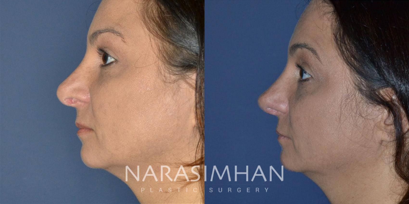 Before & After Revision Rhinoplasty Case 195 View #1 View in St. Petersburg, Florida