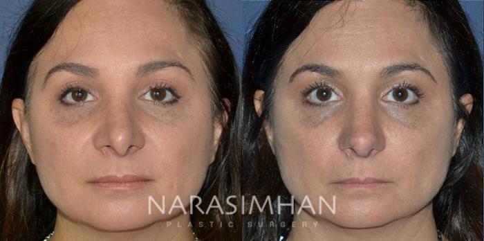 Before & After Revision Rhinoplasty Case 195 View #2 View in Tampa, Florida