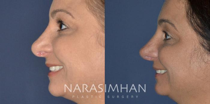 Before & After Revision Rhinoplasty Case 195 View #3 View in Tampa, Florida