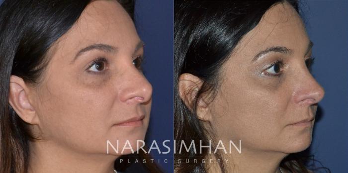 Before & After Revision Rhinoplasty Case 195 View #4 View in Tampa, Florida