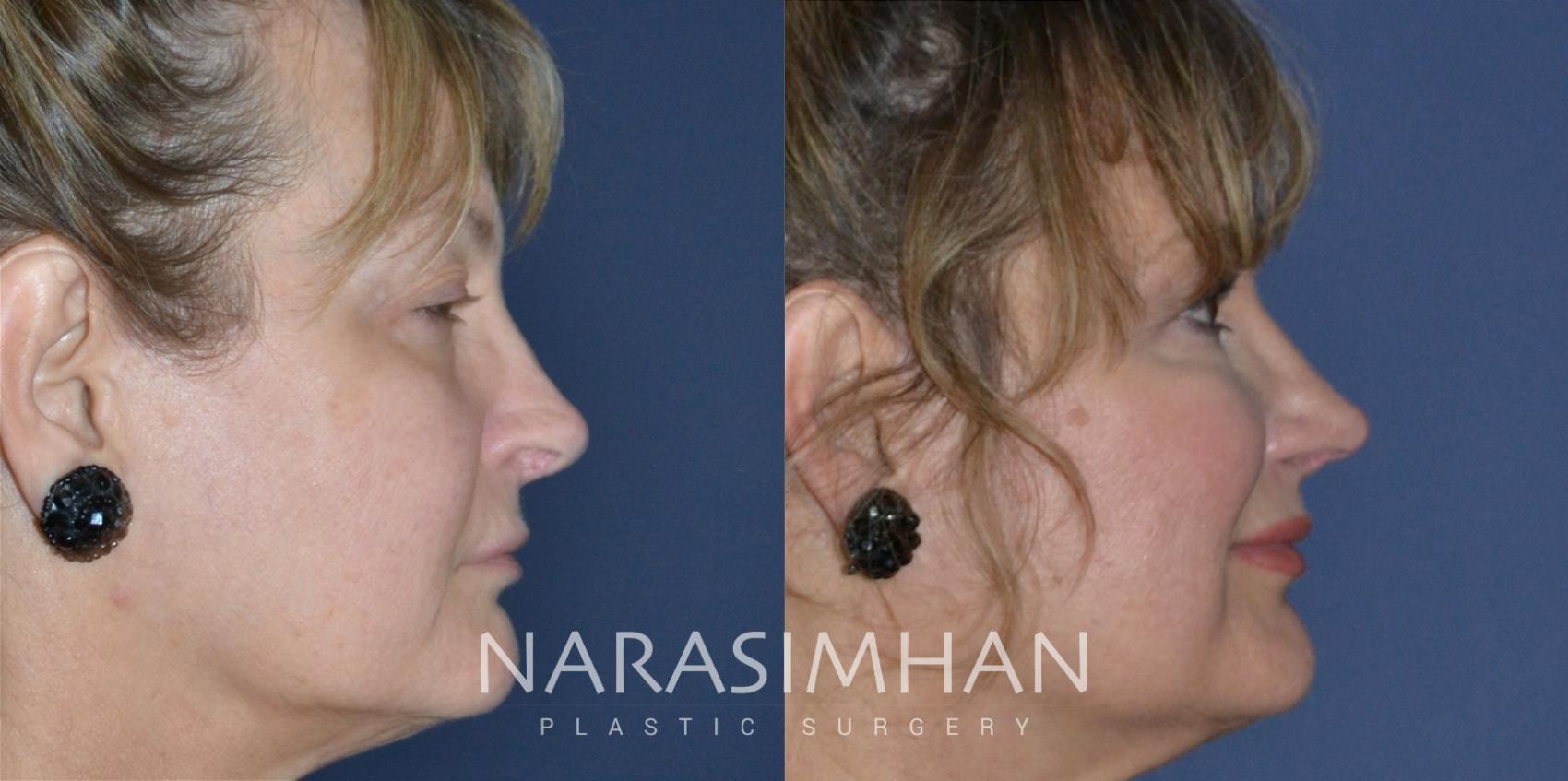 Before & After Revision Rhinoplasty Case 203 View #1 View in St Petersburg, Florida