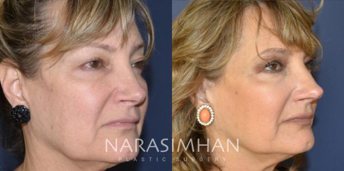 Before & After Revision Rhinoplasty Case 203 View #2 View in Tampa, Florida