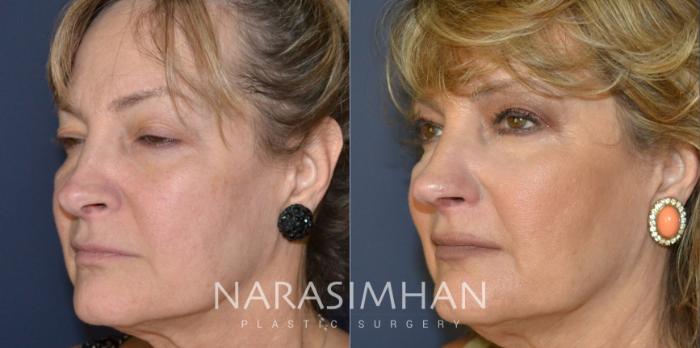 Before & After Revision Rhinoplasty Case 203 View #3 View in Tampa, Florida