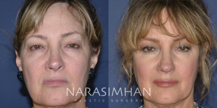 Before & After Revision Rhinoplasty Case 203 View #4 View in Tampa, Florida