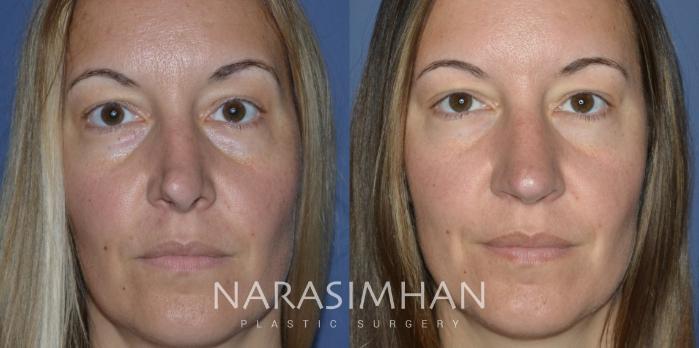 Before & After Revision Rhinoplasty Case 298 Front not smiling View in Tampa, Florida