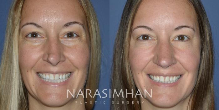 Before & After Revision Rhinoplasty Case 298 Front View in Tampa, Florida