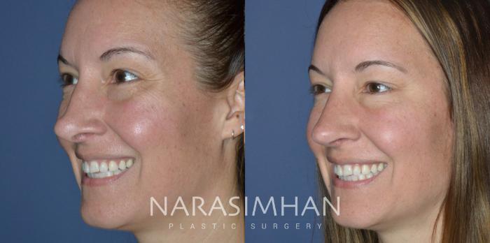 Before & After Revision Rhinoplasty Case 298 Left Oblique View in Tampa, Florida