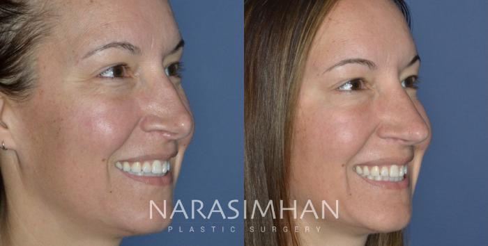 Before & After Revision Rhinoplasty Case 298 Right Oblique View in Tampa, Florida