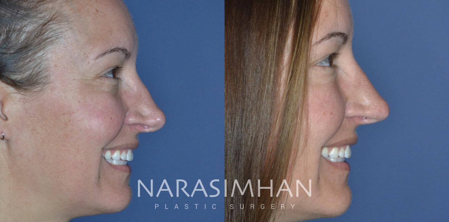 Before & After Revision Rhinoplasty Case 298 Right Side View in St Petersburg, Florida