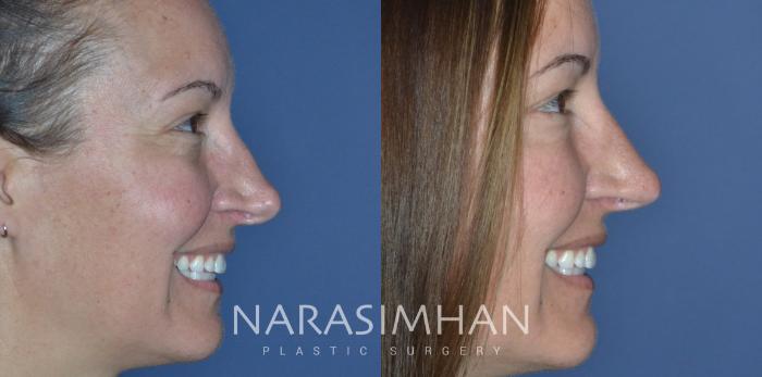 Before & After Revision Rhinoplasty Case 298 Right Side View in Tampa, Florida