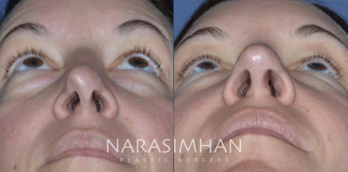 Before & After Revision Rhinoplasty Case 298 Upward View in Tampa, Florida