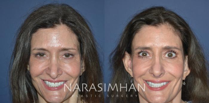 Before & After Revision Rhinoplasty Case 332 Front View in Tampa, Florida