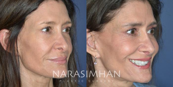 Before & After Revision Rhinoplasty Case 332 Right Oblique View in Tampa, Florida