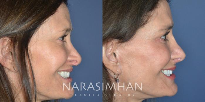 Before & After Revision Rhinoplasty Case 332 Right Side View in Tampa, Florida