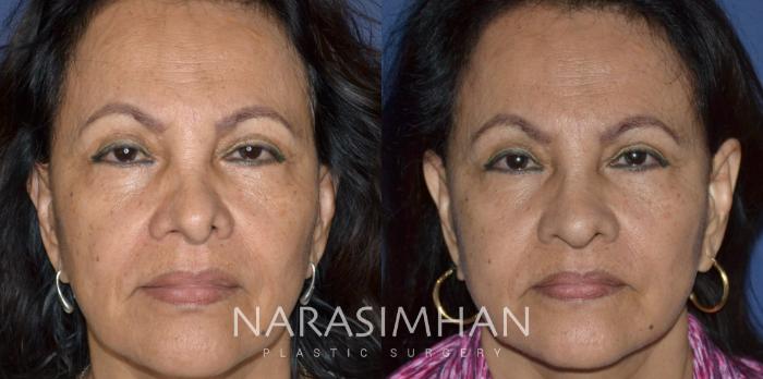 Before & After Revision Rhinoplasty Case 334 Front View in Tampa, Florida