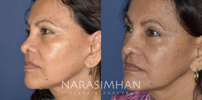 Before & After Revision Rhinoplasty Case 334 Left Oblique View in Tampa, Florida